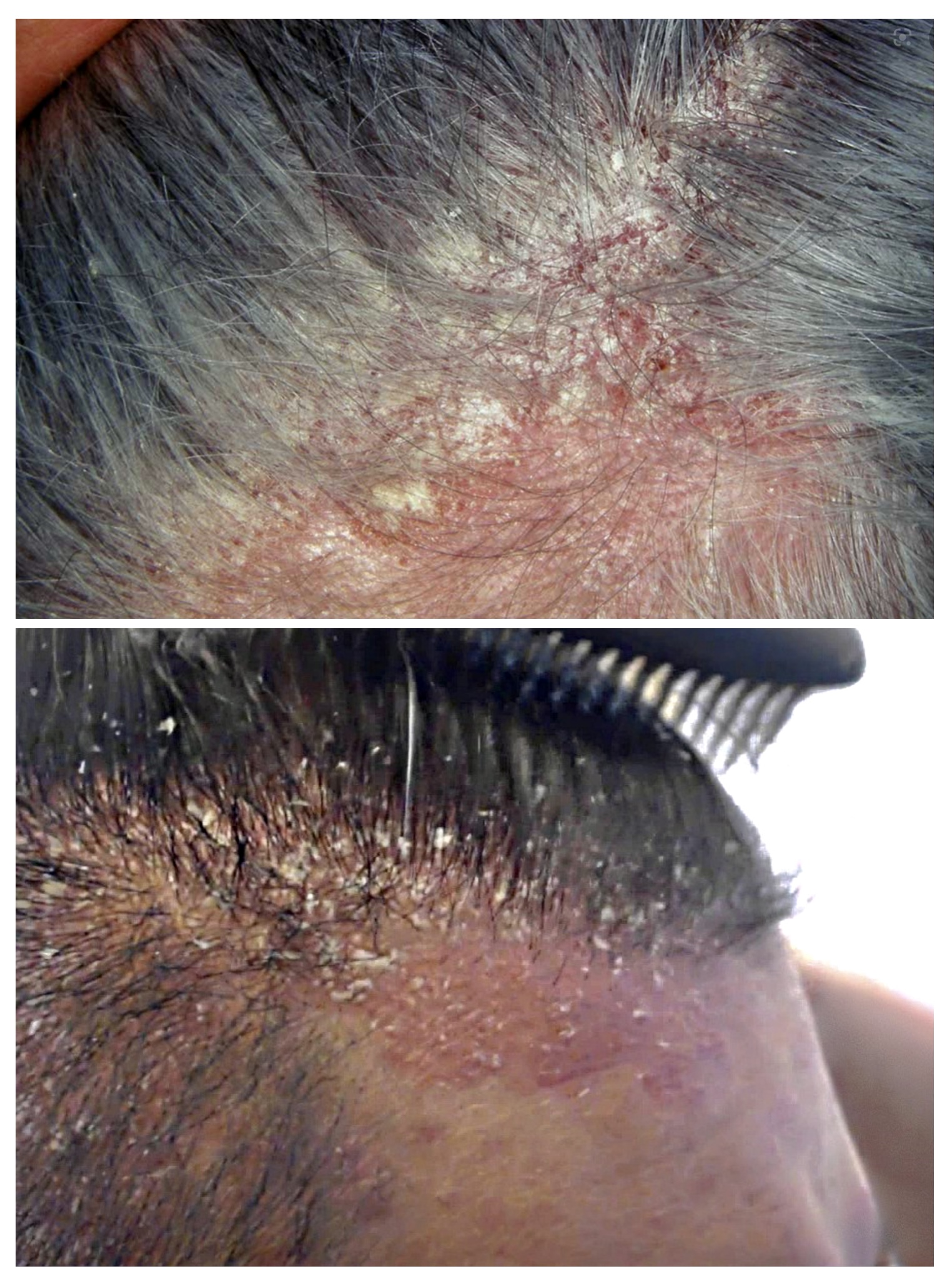Dermatite capelli